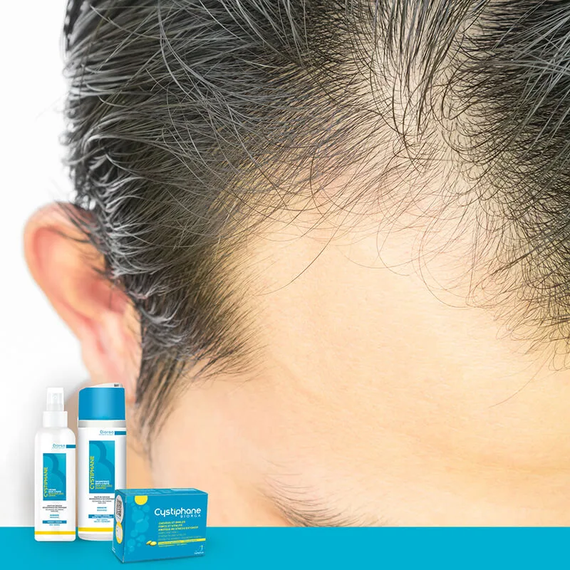 تعرفوا على أسباب تساقط الشعر عند الشباب و كيفية الحصول على شعر كثيف